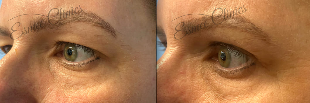 Before and After img